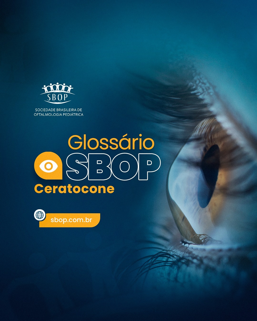 Glossário SBOP – Ceratocone