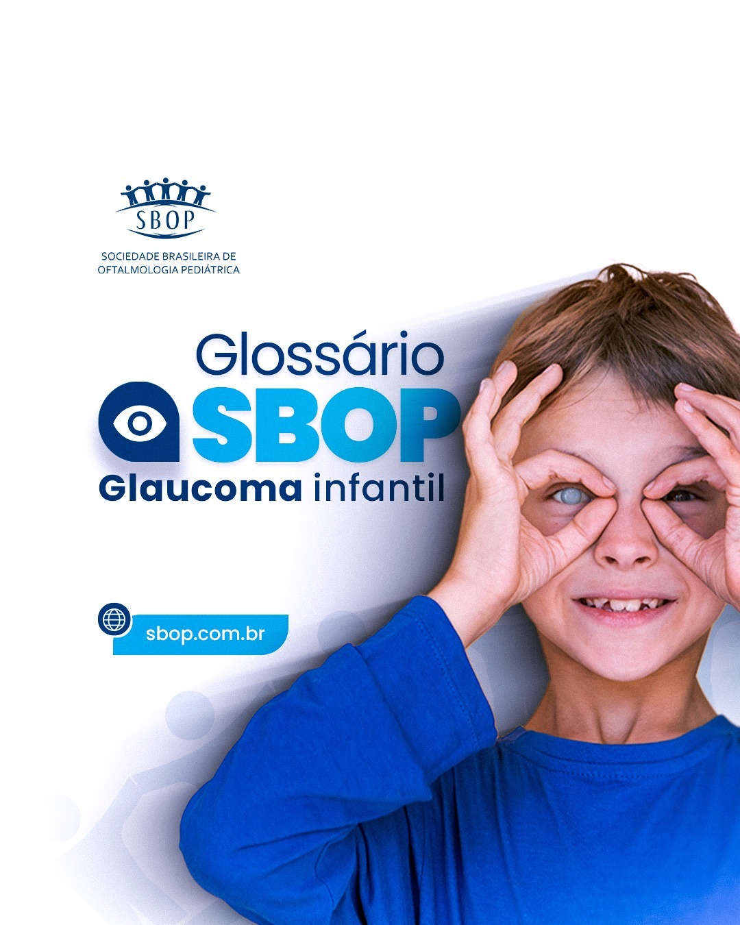 Glossário SBOP – Glaucoma infantil